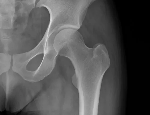 Calcificazione Anca: Sintomi, Cause e Cure Efficaci