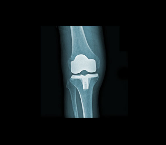 Protesi ginocchio post