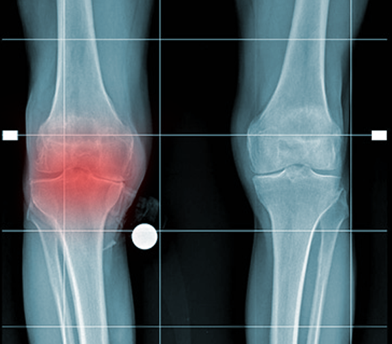 La protesi totale del ginocchio - prima dell'operazione