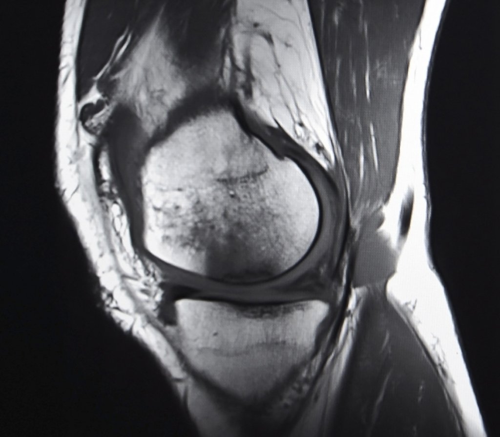 ricostruzione della cartilagine del ginocchio